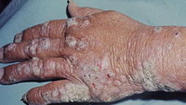 Leprosy (Hansen's disease, leprosy)